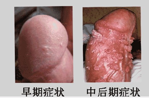 陰囊上長疙瘩是怎么回事